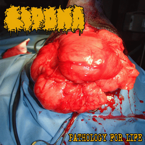 Lipoma : Pathology for Life